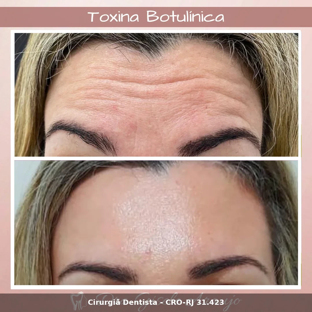 Harmonização Facial — Dra. Gisele Araujo