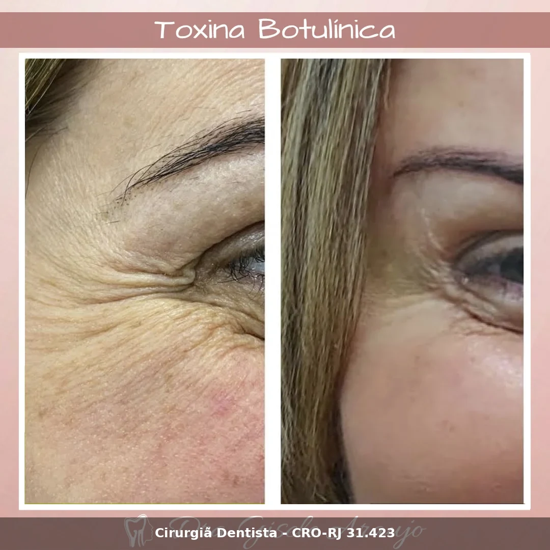 Harmonização Facial — Dra. Gisele Araujo