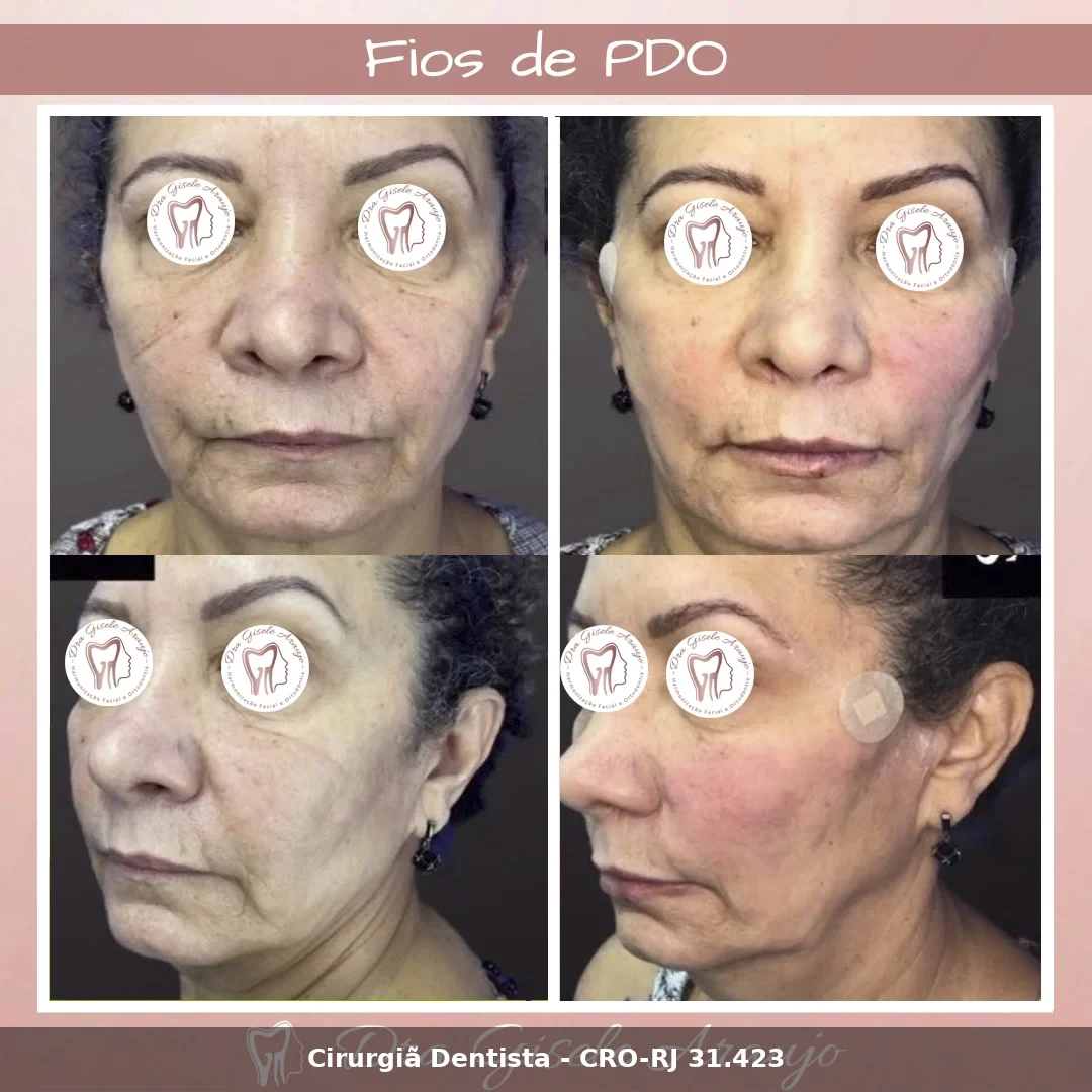 Harmonização Facial — Dra. Gisele Araujo
