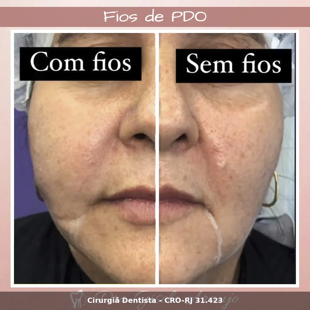 Harmonização Facial — Dra. Gisele Araujo