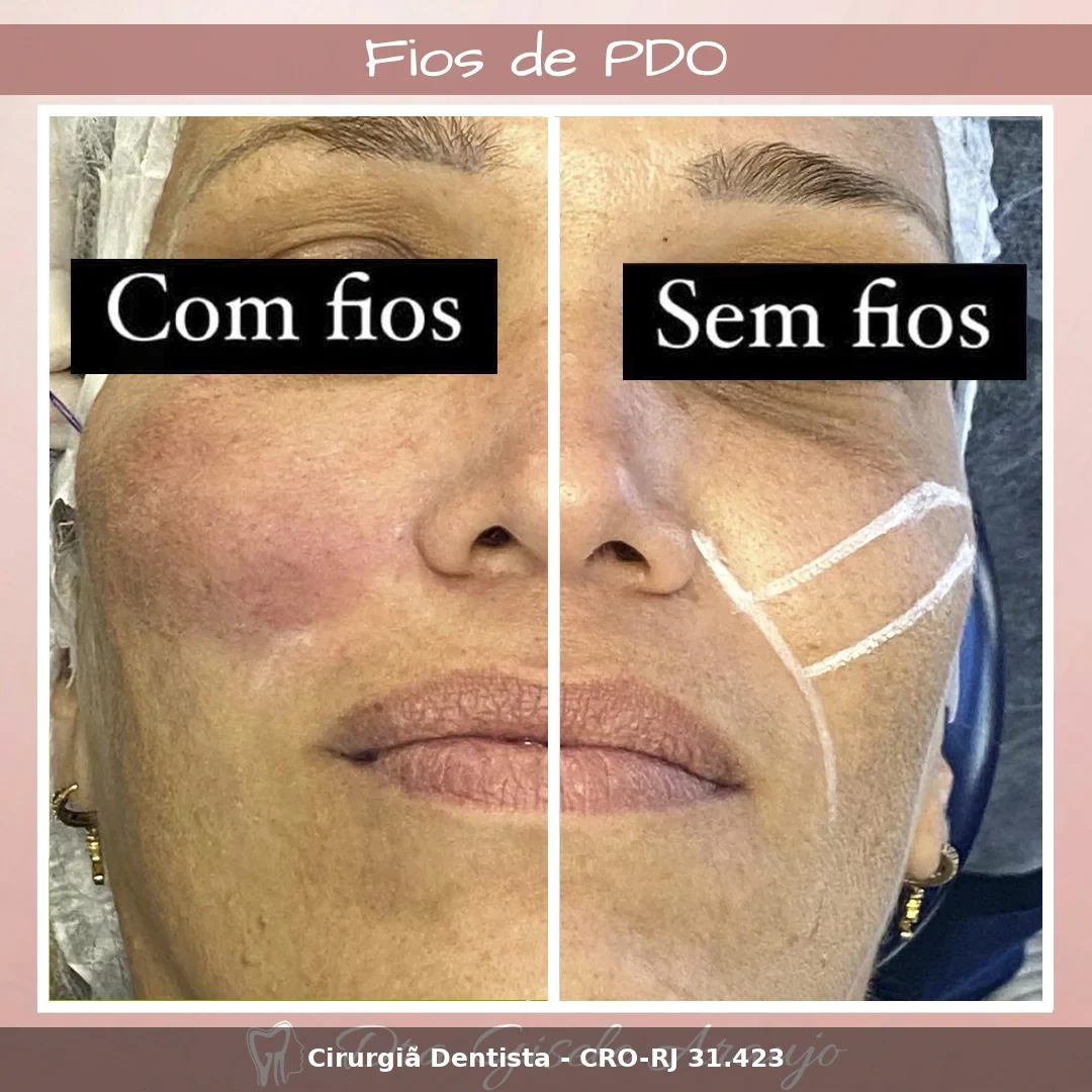 Harmonização Facial — Dra. Gisele Araujo