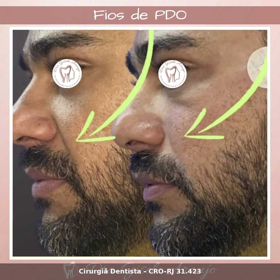 Harmonização Facial — Dra. Gisele Araujo