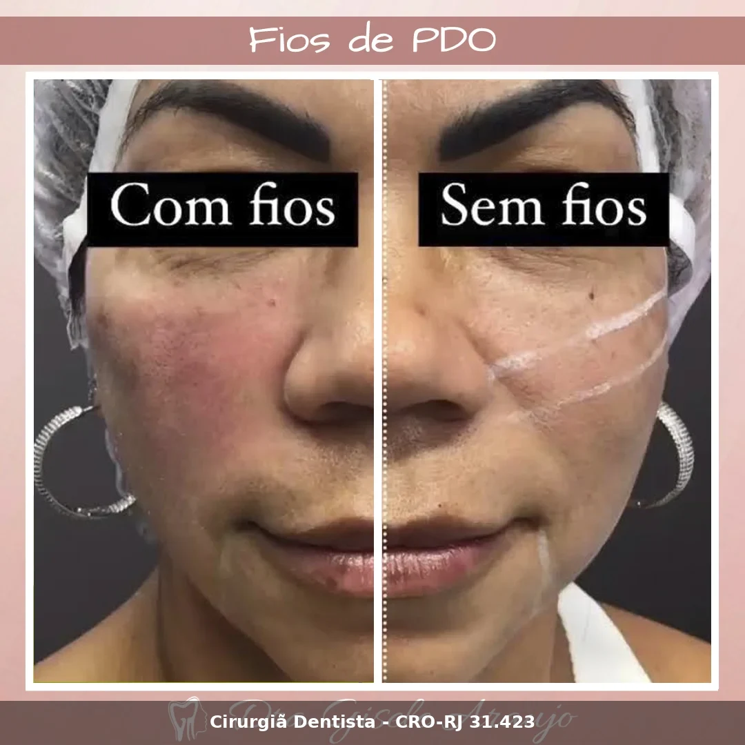 Harmonização Facial — Dra. Gisele Araujo