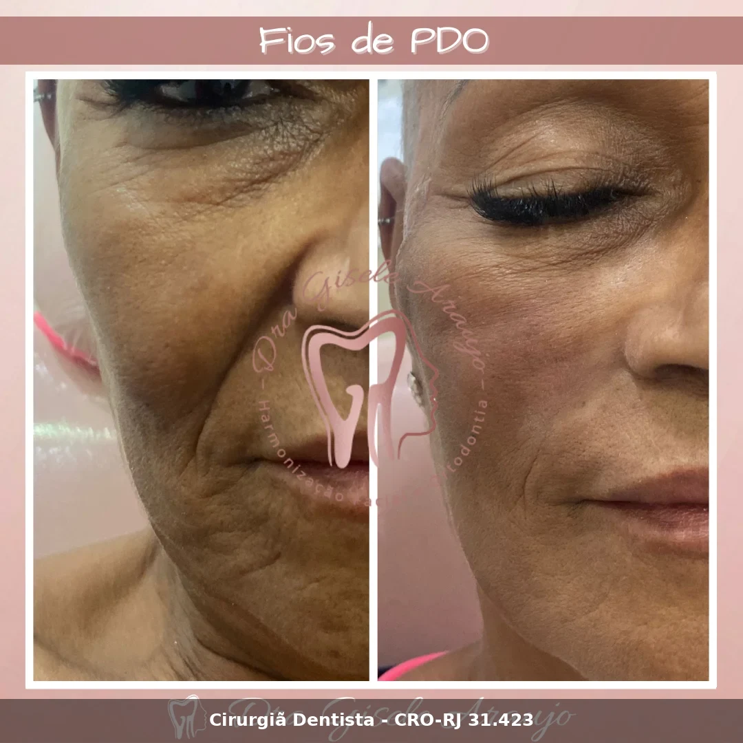 Harmonização Facial — Dra. Gisele Araujo