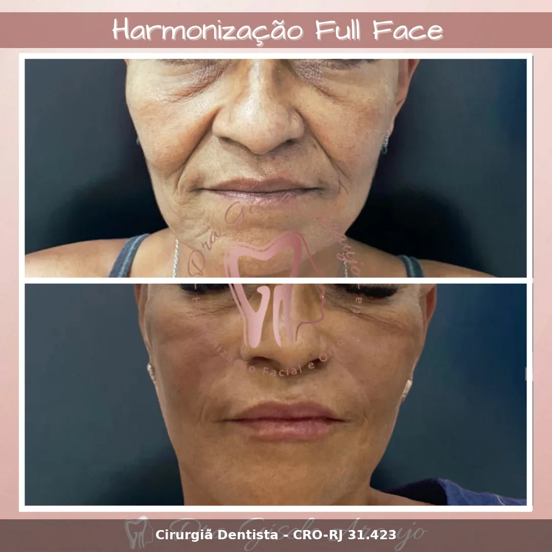 Harmonização Facial — Dra. Gisele Araujo