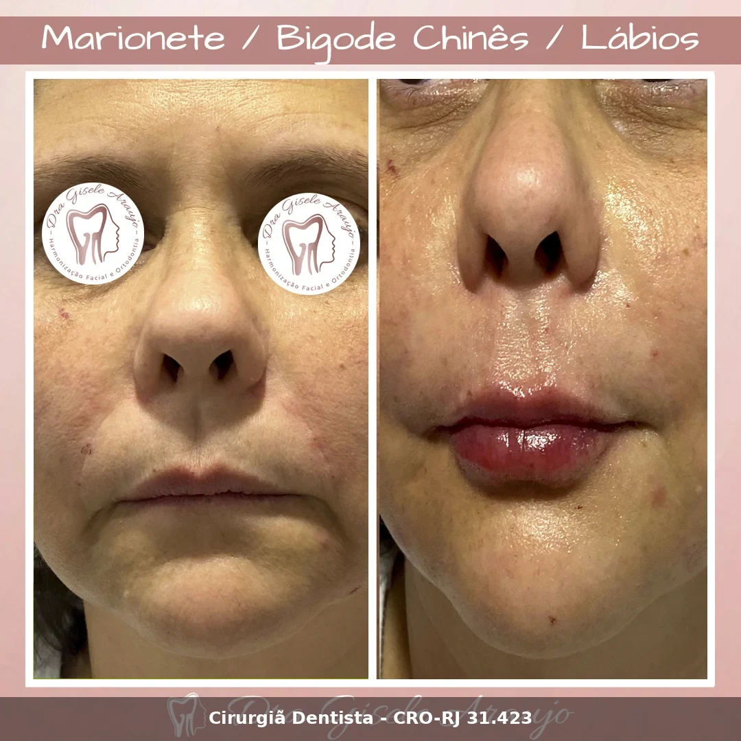 Harmonização Facial — Dra. Gisele Araujo