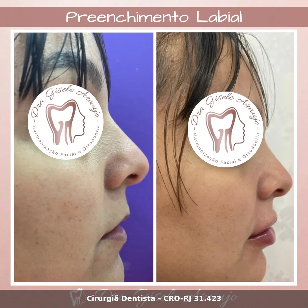 Harmonização Facial — Dra. Gisele Araujo