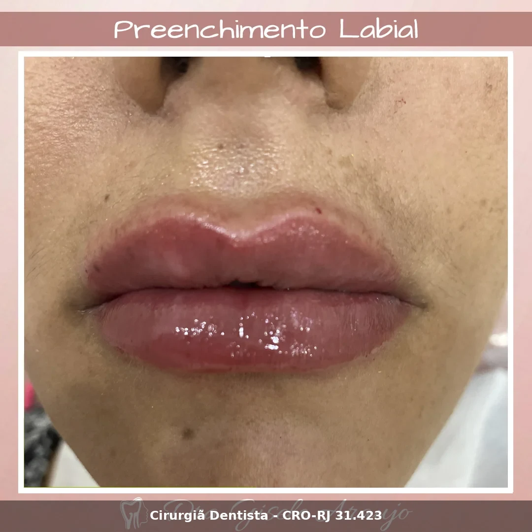 Harmonização Facial — Dra. Gisele Araujo