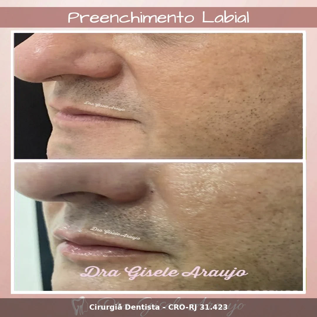 Harmonização Facial — Dra. Gisele Araujo