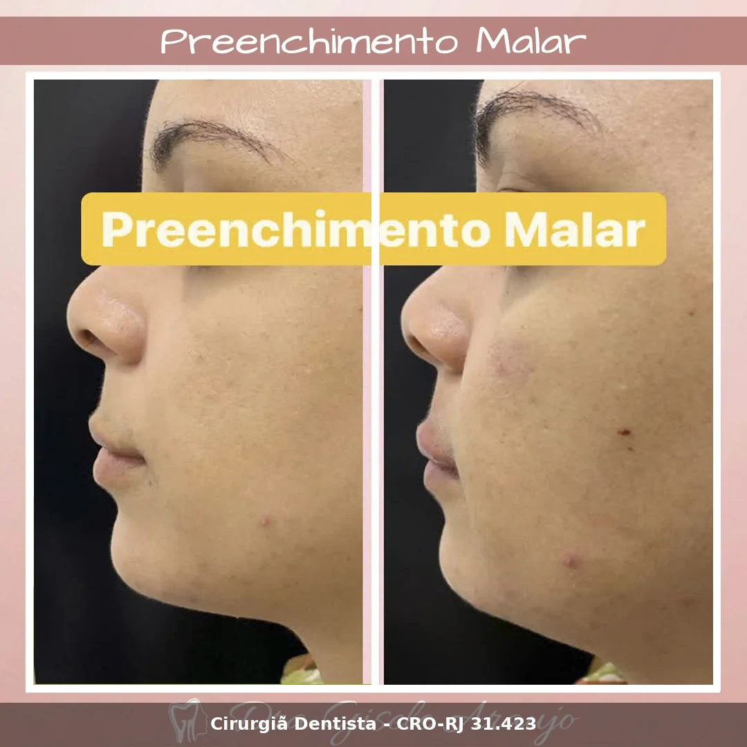 Harmonização Facial — Dra. Gisele Araujo