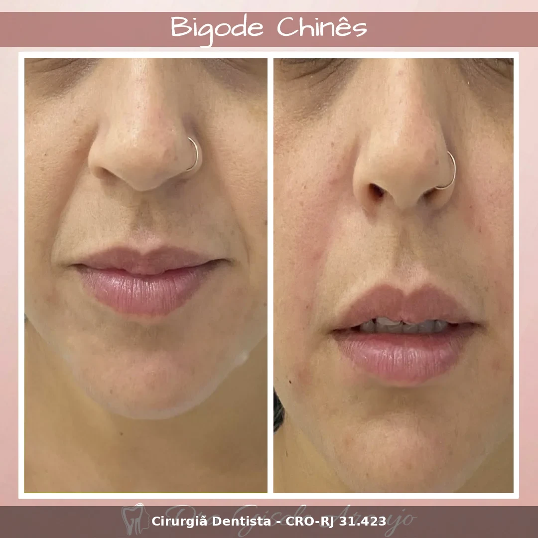 Harmonização Facial — Dra. Gisele Araujo