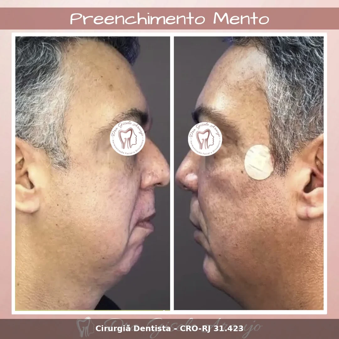Harmonização Facial — Dra. Gisele Araujo