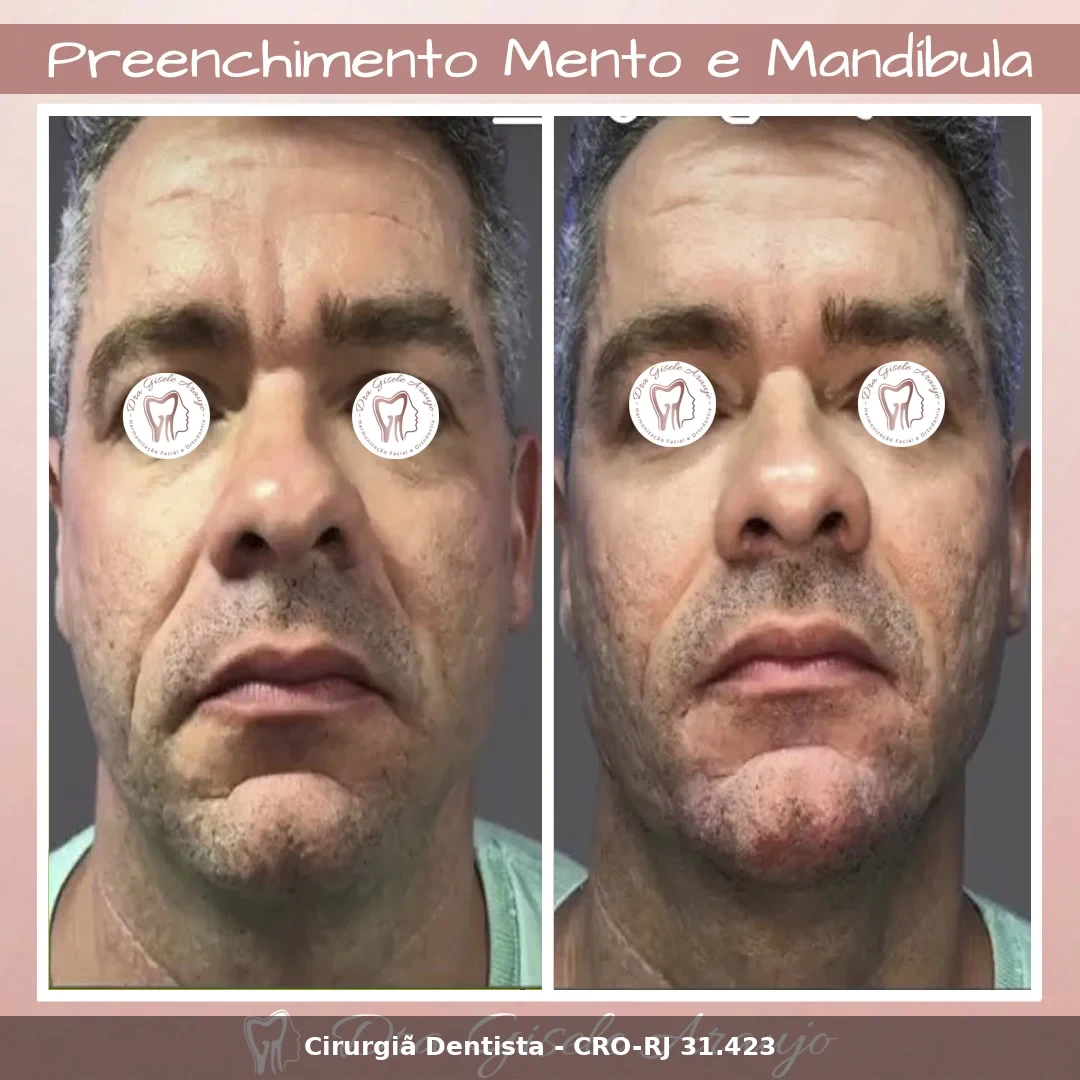 Harmonização Facial — Dra. Gisele Araujo
