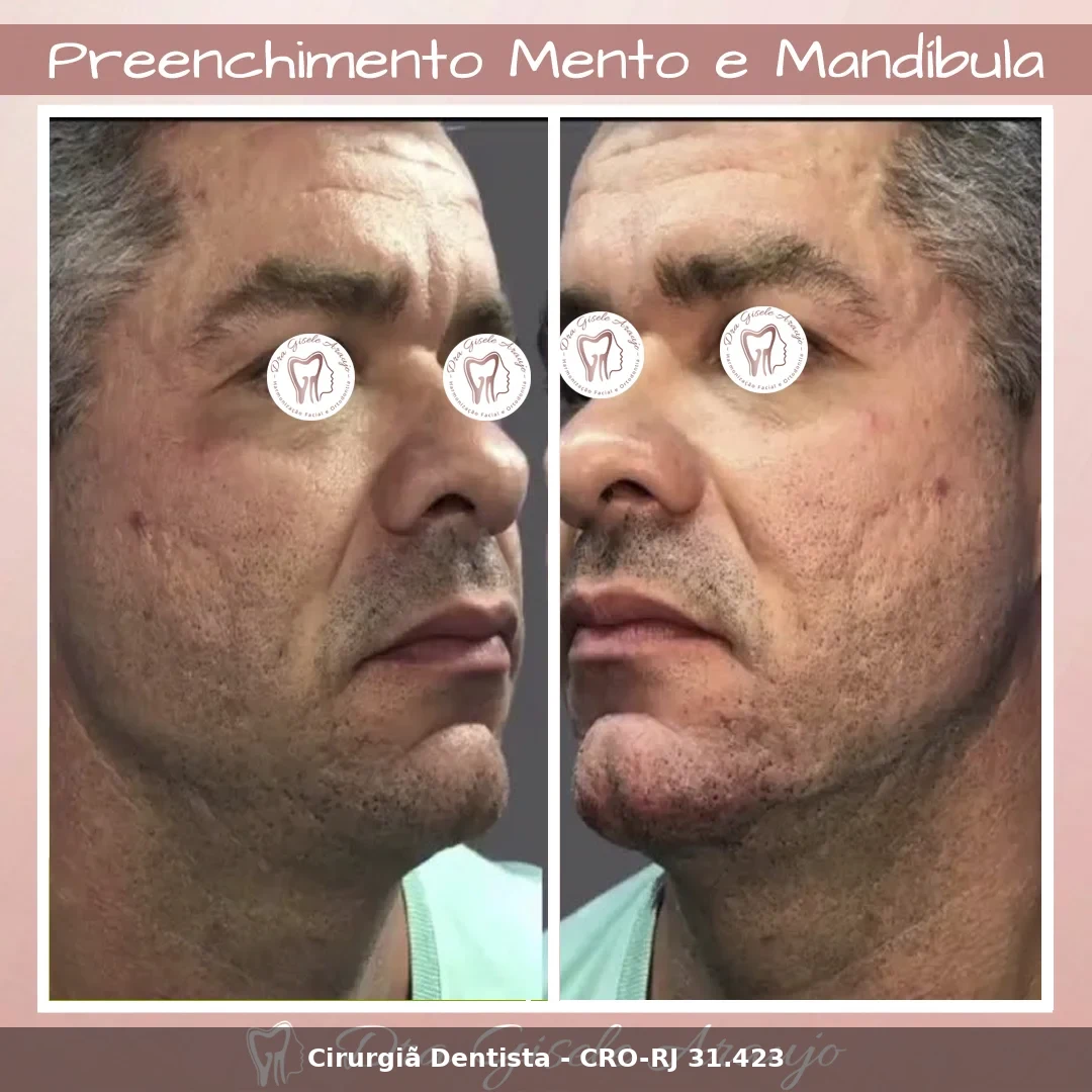 Harmonização Facial — Dra. Gisele Araujo