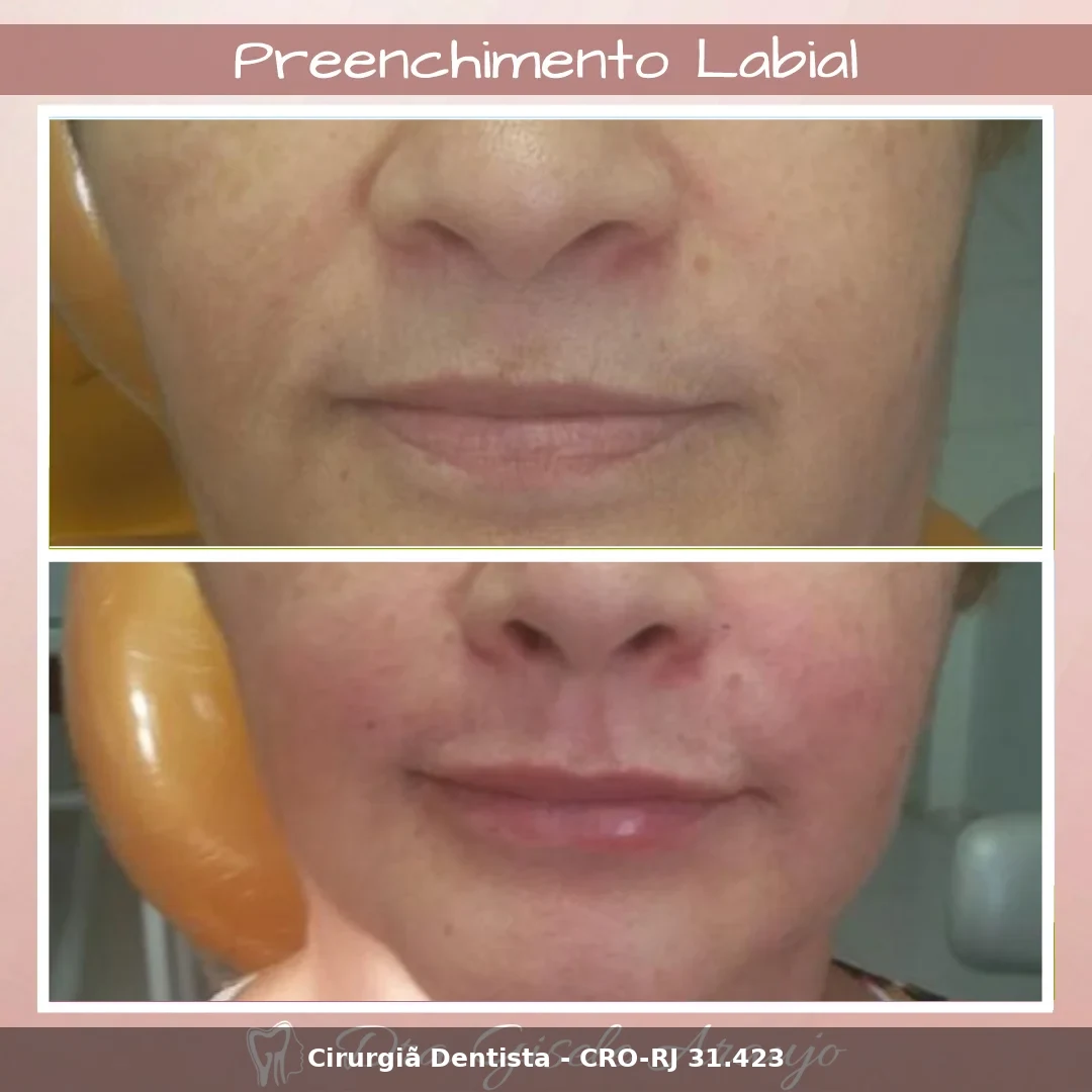 Harmonização Facial — Dra. Gisele Araujo