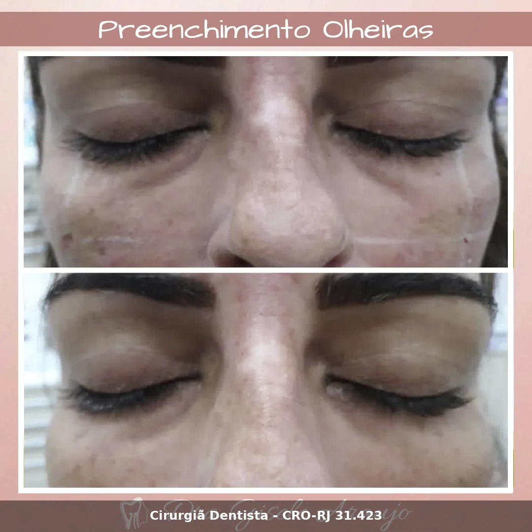 Harmonização Facial — Dra. Gisele Araujo