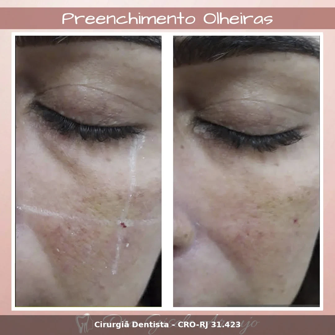 Harmonização Facial — Dra. Gisele Araujo