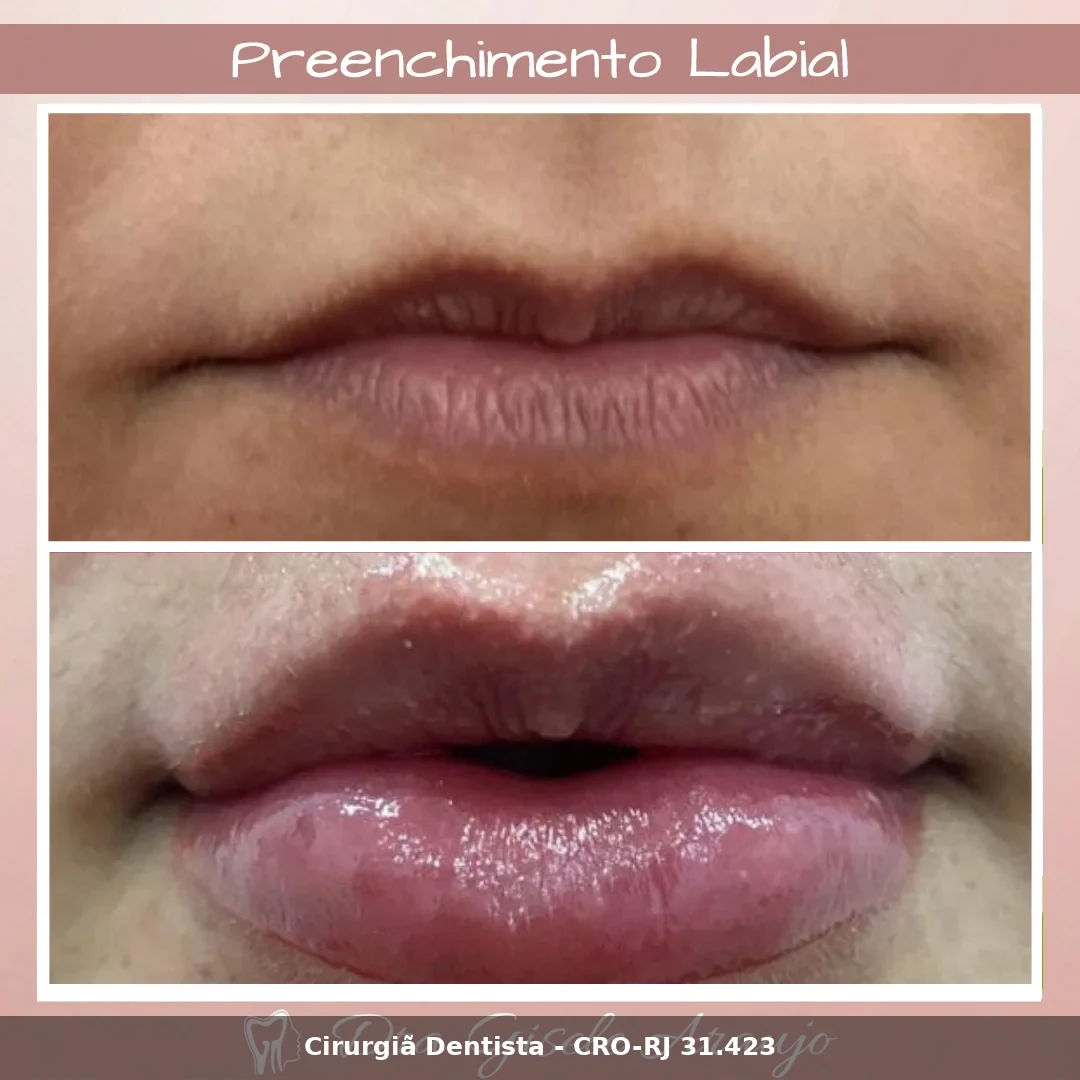 Harmonização Facial — Dra. Gisele Araujo