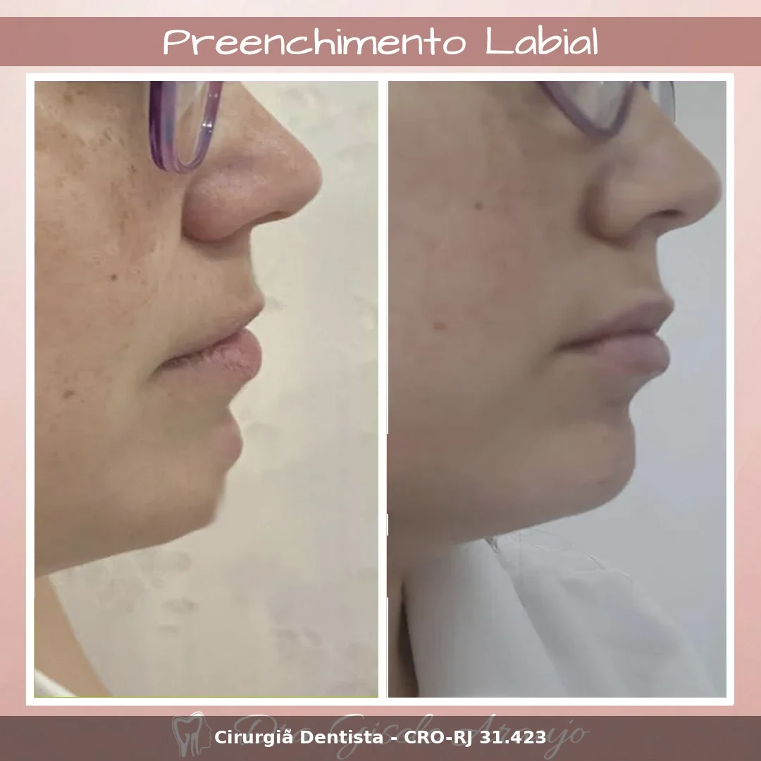 Harmonização Facial — Dra. Gisele Araujo