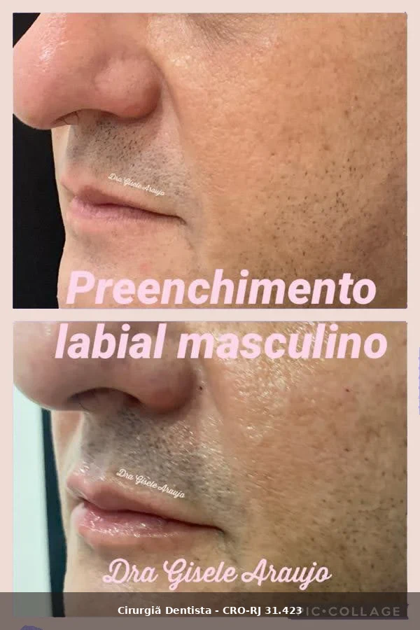 Harmonização Facial — Dra. Gisele Araujo