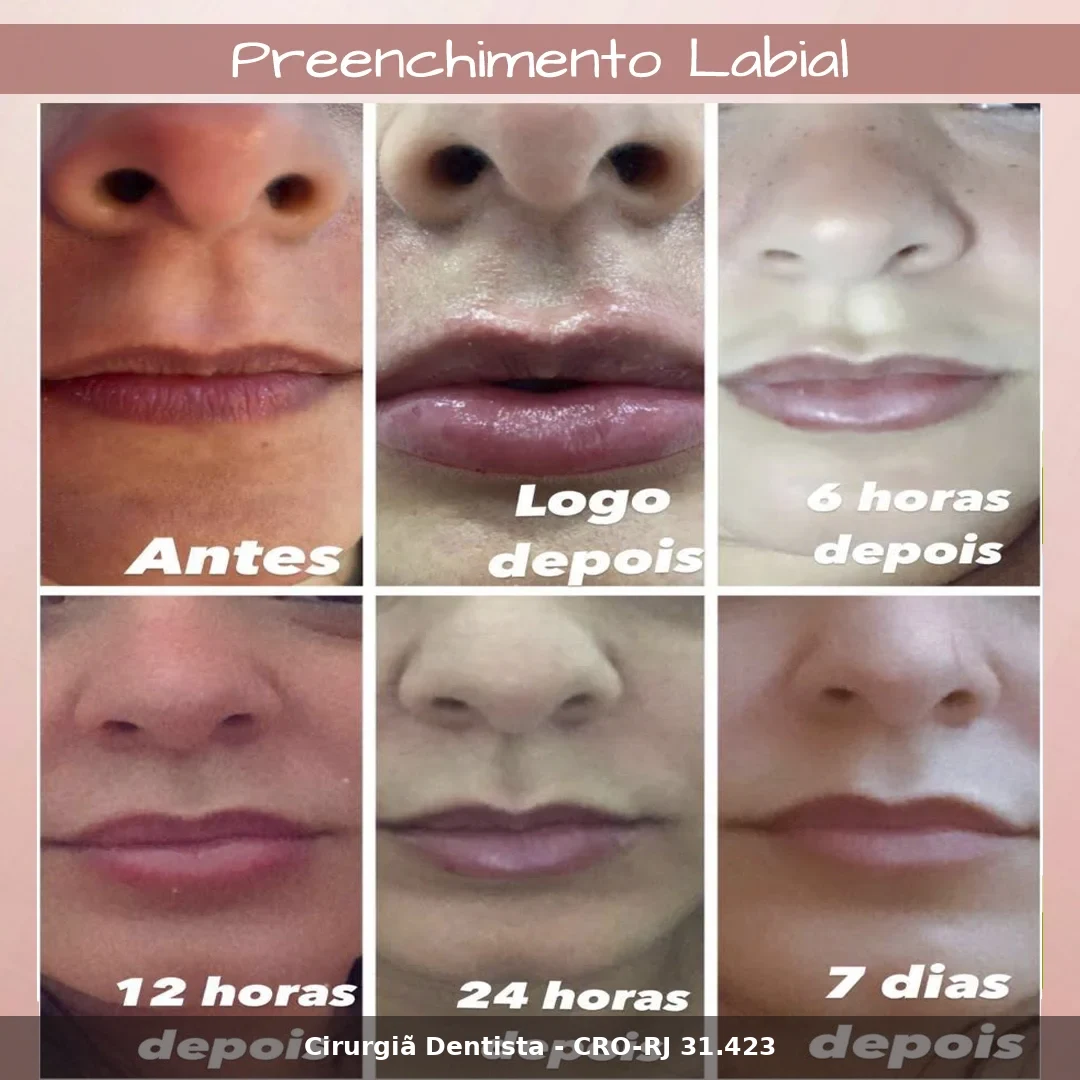 Harmonização Facial — Dra. Gisele Araujo