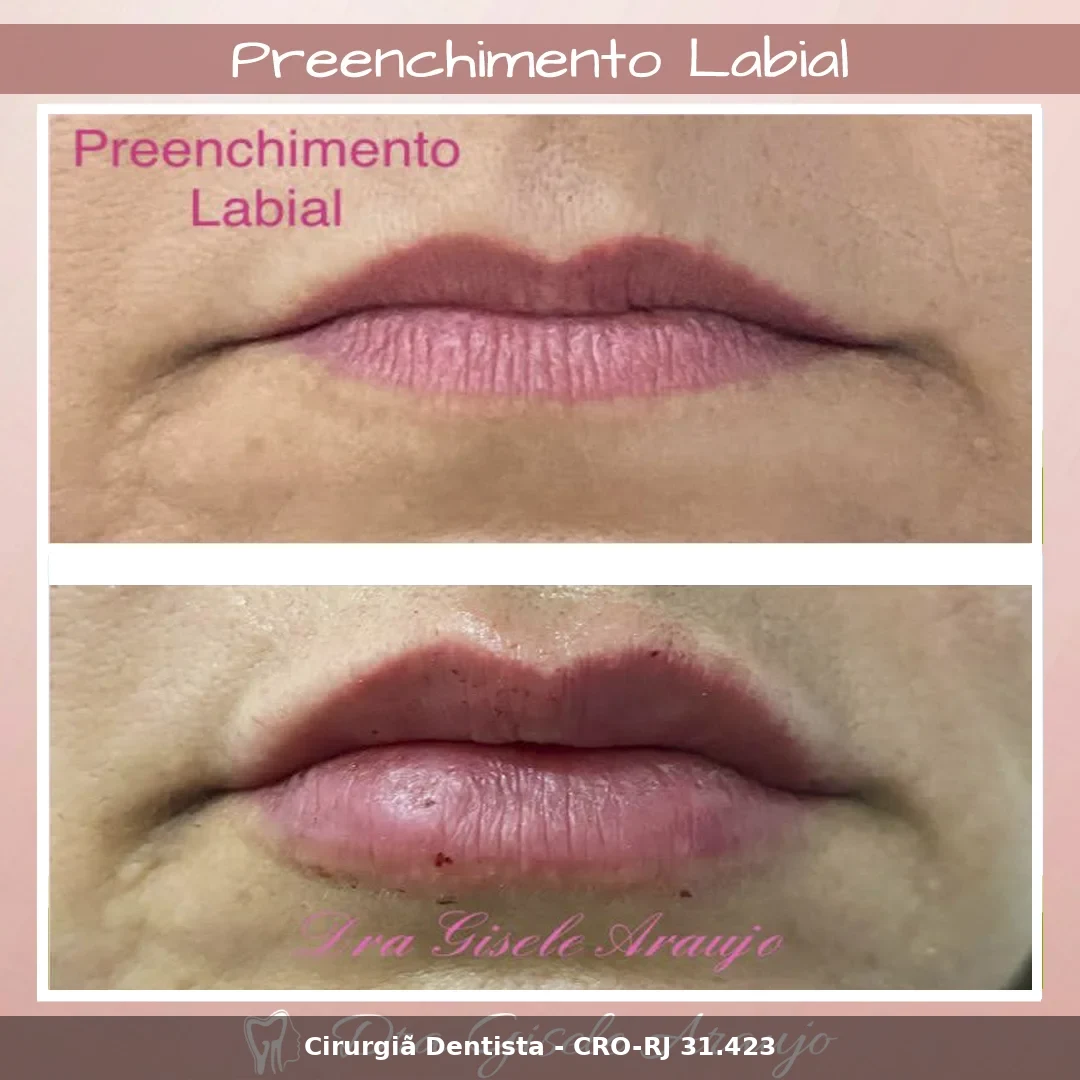 Harmonização Facial — Dra. Gisele Araujo