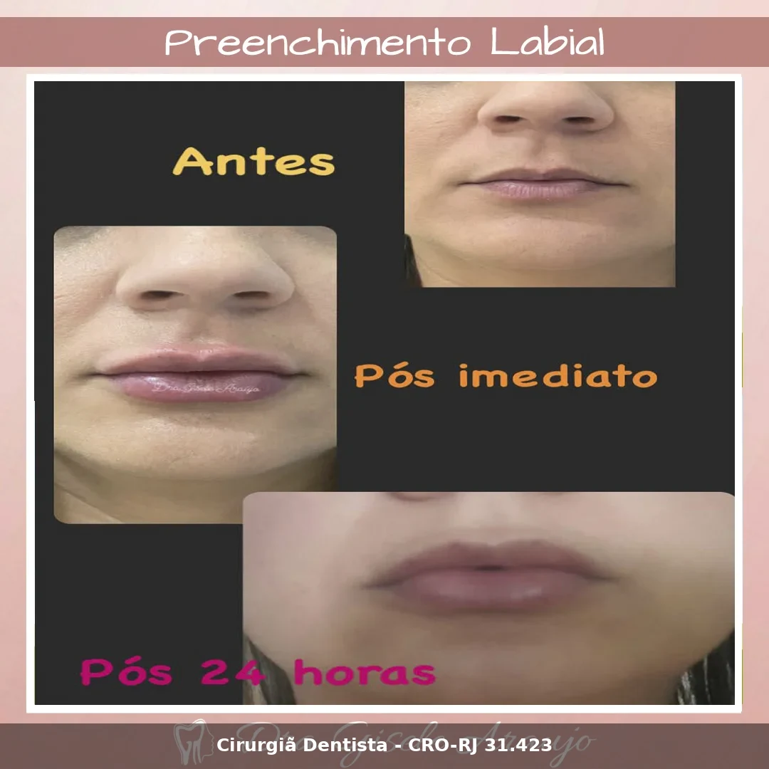 Harmonização Facial — Dra. Gisele Araujo