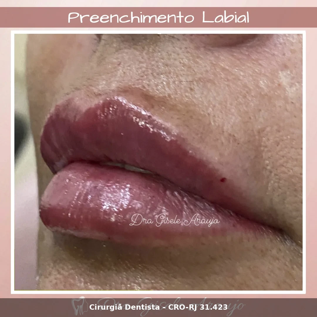 Harmonização Facial — Dra. Gisele Araujo